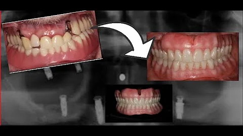 Snap-In Complete Dentures