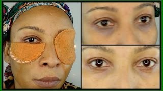 POWERFUL HOME REMEDY FOR DARK UNDER EYE CIRCLES, WRINKLES & EYE BAGS.RESULT IN 7 DAYS |Khichi Beauty