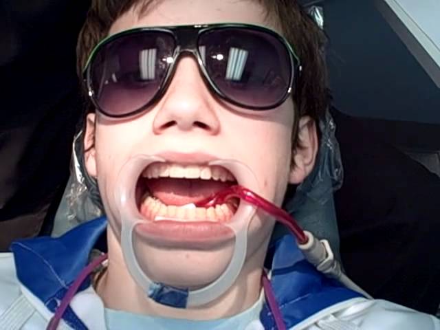 Getting My Braces Off Final Stage Youtube Getting My Braces Off Final Stage Youtube