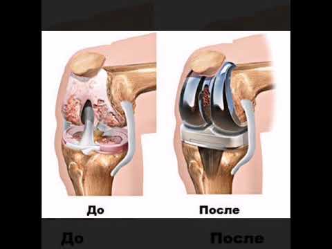эндопротез