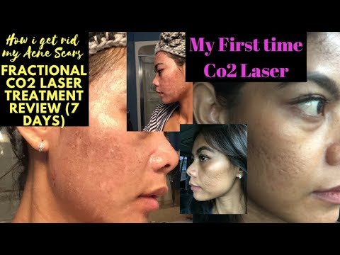 Acne Scars Removal (First time Co laser treatment  Days Review)