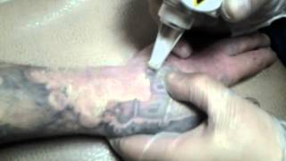 видео лазер для удаления татуировок
