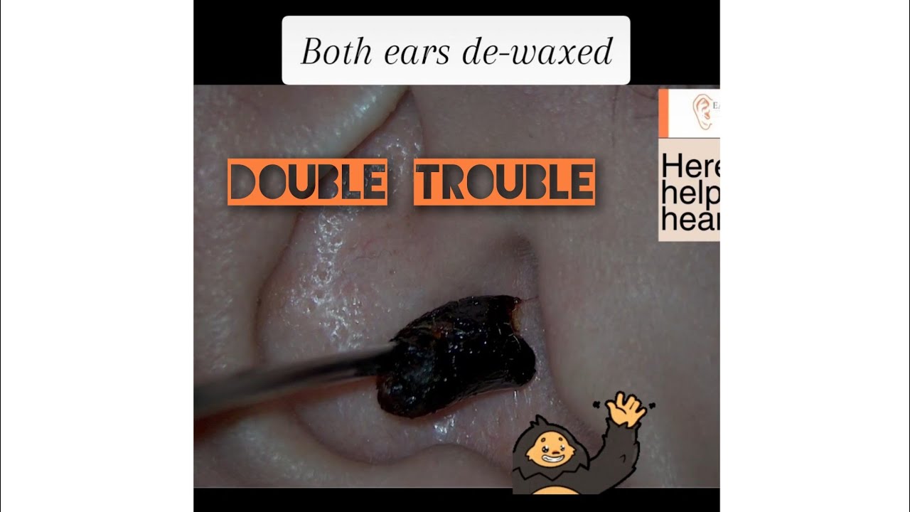BOTH ears blocked 🚫 Bilateral ear wax plug removal earwaxremoval 