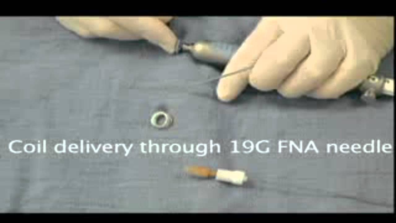 cyanoacrylate glue obliteration of gastric fundal varices YouTube
