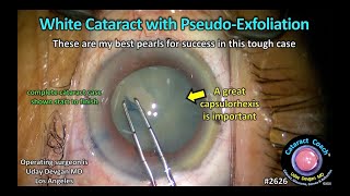 Cataractcoach 2626 White Cataract With Pseudo-Exfoliation Complete Cataract Case