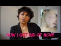 HOW TO GET RID OF ACNE.... | MY SKIN ROUTINE.