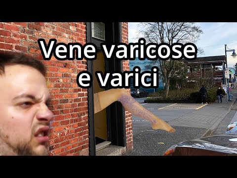 VENE VARICOSE E VARICI - - Spiegazione