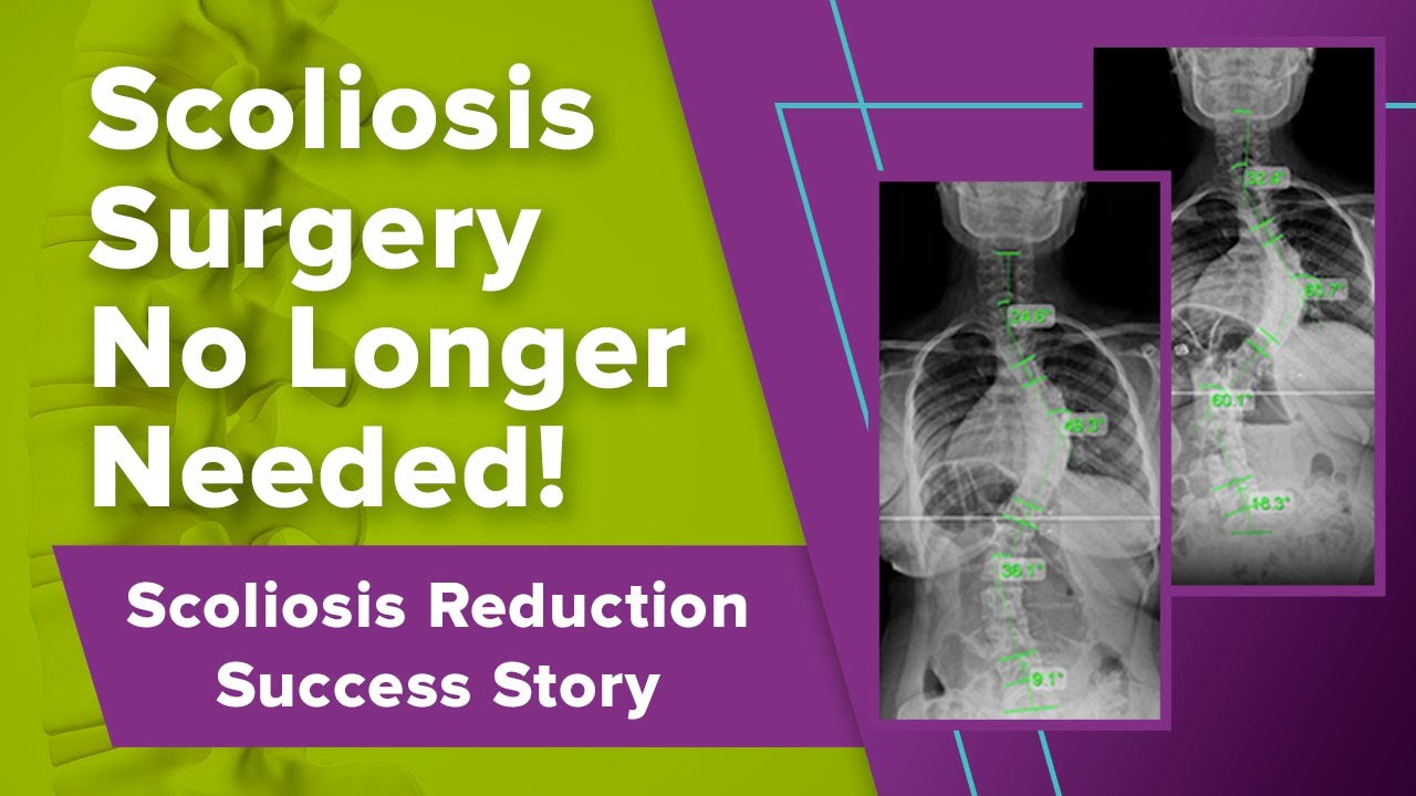 Scoliosis Surgery No Longer Needed! Scoliosis Reduction Success Story