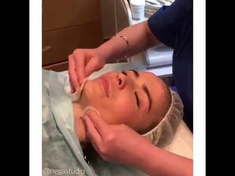 Щелочной пилинг лица в салоне