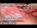 स र यस स Psoriasis क इल ज कर प र न स भ प र न कभ ठ क नह ह न व ल आज ह स पर क कर स र यस स Psoriasis क इल ज कर प र न स भ प र न कभ ठ क नह ह न व ल आज ह स पर क कर