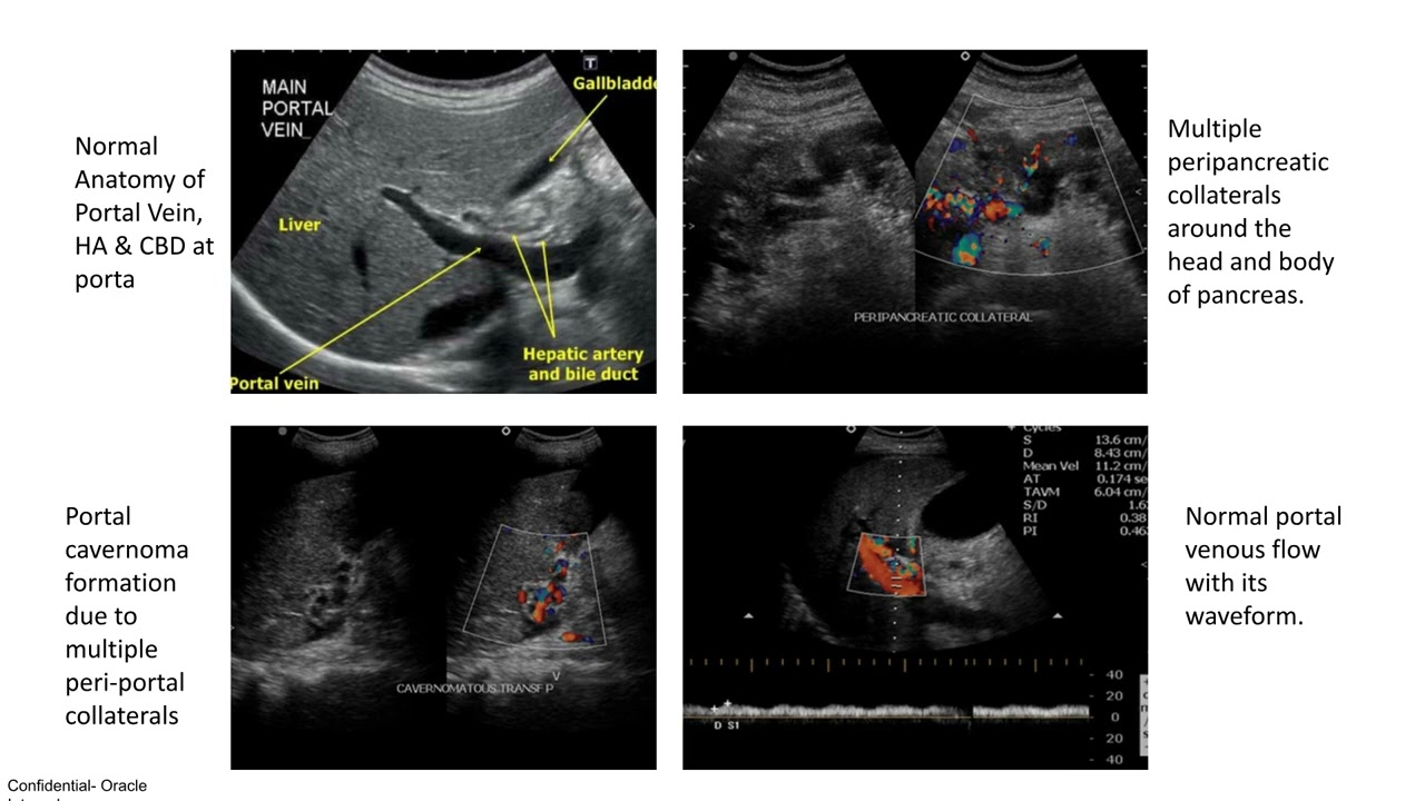 Шикха Кумари | УЗИ и цветная допплерография при портальной гипертензии