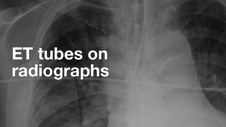 ET Tubes on Chest X-ray