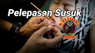 susuk viral  Prosesi Pelepasan Susuk Yang di pasang di bibir