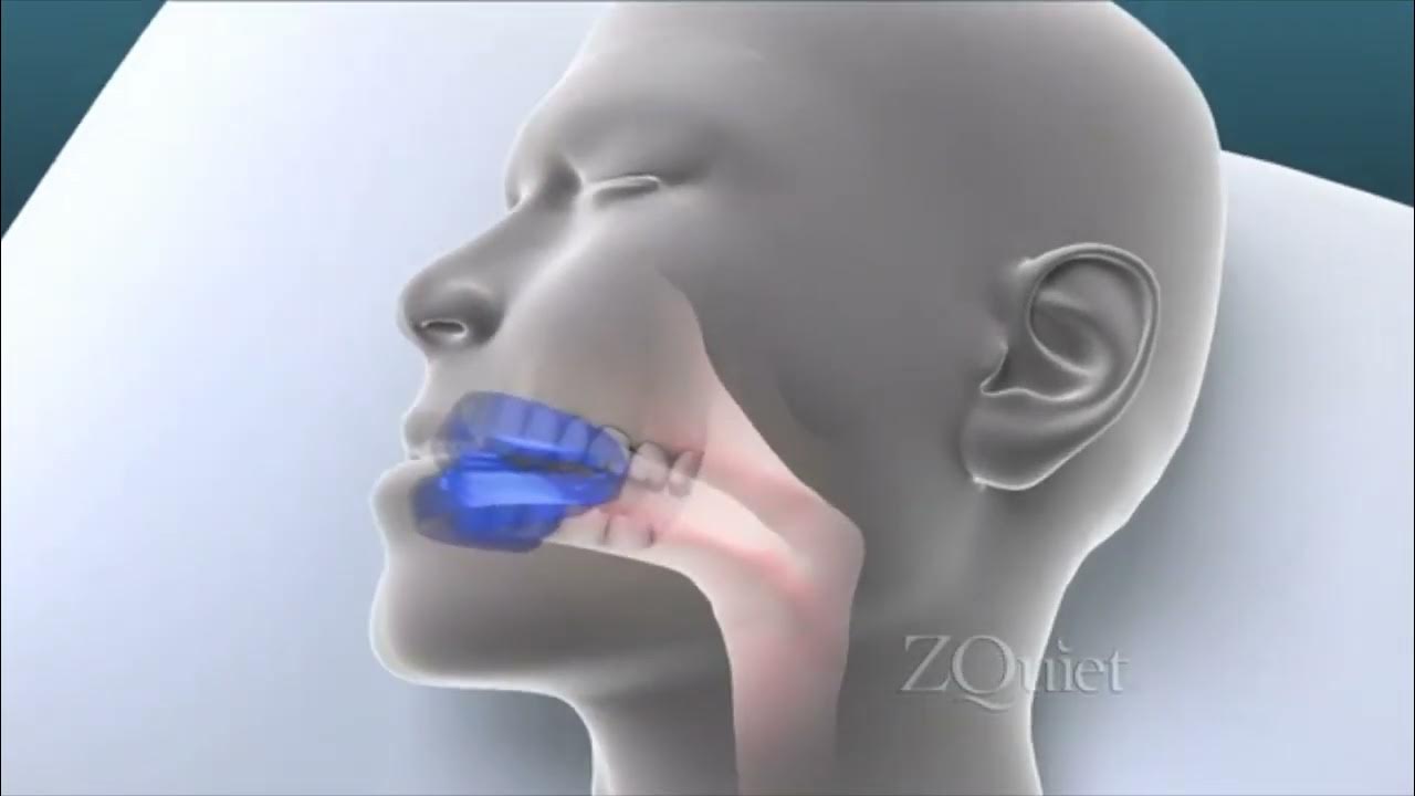 ZQuiet AntiSnoring Mouthpiece How It Works YouTube