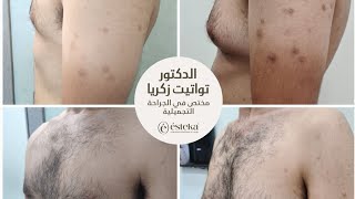 جراحة التثدي عند الرجل الدكتور تواتيت زكريا جراحة التجميل والحروق