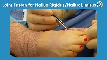 Fusion of Great Toe Joint for Hallux Rigidus/Hallux Limitus