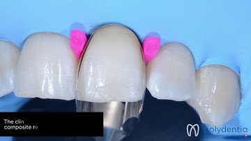 Replacing an old Class V restoration using Unica anterior