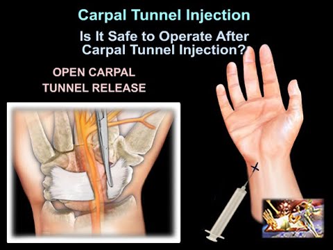 Carpal Tunnel Injection - Everything You Need To Know - Dr. Nabil