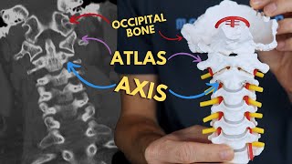 Atlantoaxial and Atlanto-occipital Joints | C1 & C2, Atlas and Axis | Radiology Anatomy Part 1 | CT