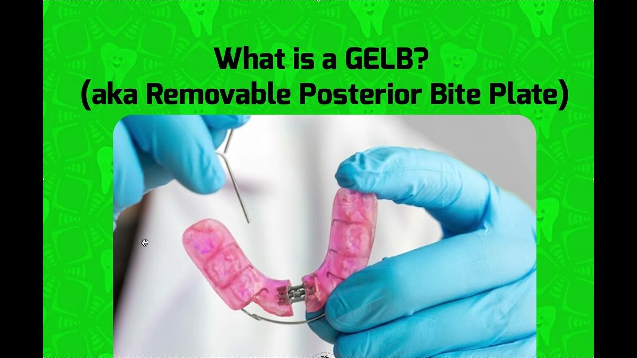 What is a GELB? (Removable Posterior Bite Plate)Good for High Angle RPE and Anterior Crossbite