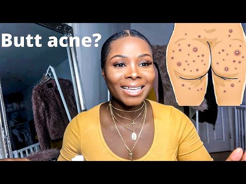 Butt acne| Booty acne| How to remove spot on the bum in 3 DAYS