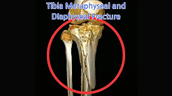 Tibia Metaphyseal and DIaphyseal Fracture
