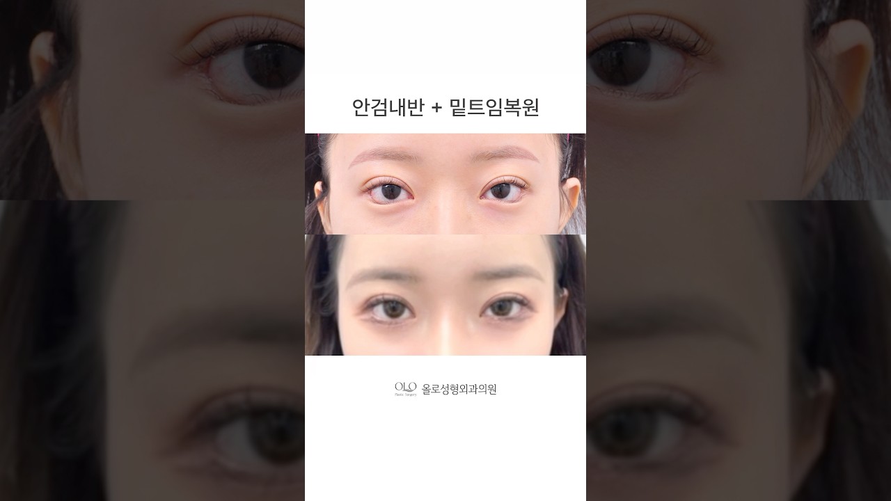 [OLLO整形外科診所] 您的最後一次眼部整形，就在OLLO 🤍 #眼瞼內翻 #下眼瞼下至修復