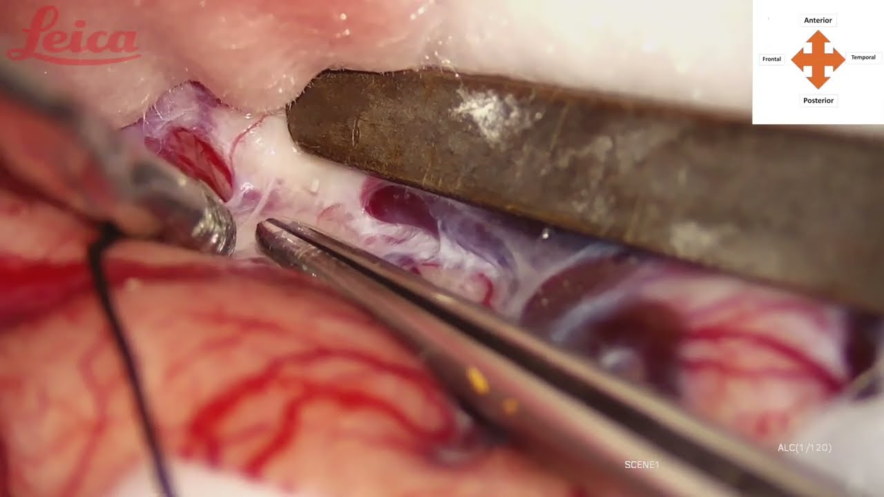 Sylvian Fissure Dissection for Beginners, Under 8 minutes video, with brief Anatomy and Diagrams