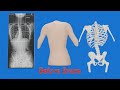 Scoliosis treatment without surgery