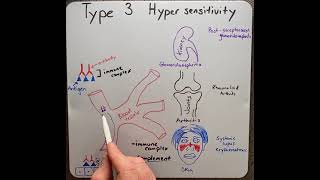 Type 3 hypersensitivity reaction in 2 mins!