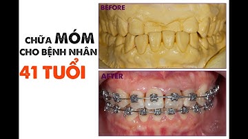 Chữa khớp cắn ngược cho bệnh nhân 41 tuổi, Chưa tới 10 tháng điều kỳ diệu đã thấy...