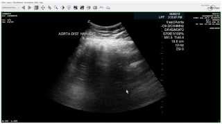 Positive Bilateral Arterial Duplex with ABI - Case Study