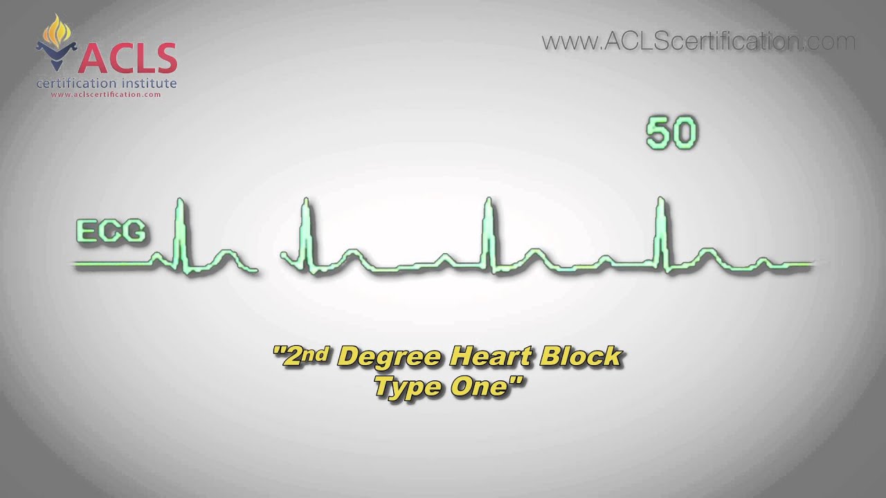 Second Degree Heart Block Type One by ACLS Certification Institute