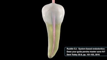 Finishing criteria with WaveOne® Gold and Dr. Ruddle | Dentsply Sirona