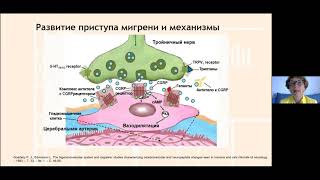 Мигрень глазами пациентов