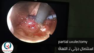 استئصال جزئي لـ اللهاة | partial uvulectomy