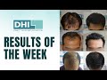 Results of the week best hair transplant clinics in indiadhiindia