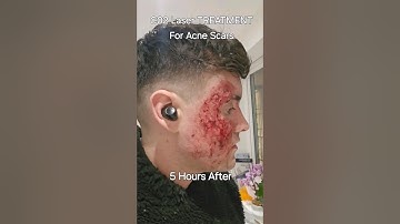 C02 Laser Acne Scars Before VS After