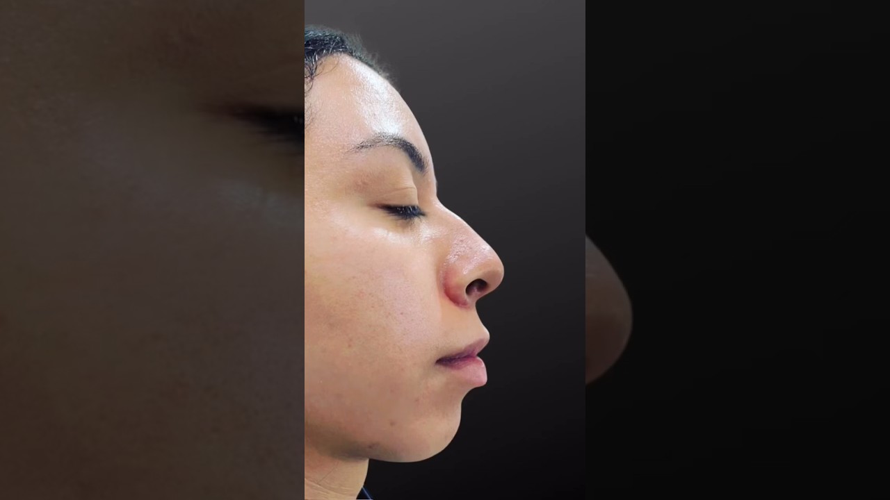 ✨ Discover the magic of Liquid Rhinoplasty with Dr. Castañeda! ✨