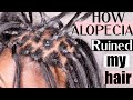 How Alopecia RUINED my hair BEFORE it fell out. Will I wear my head BALD?