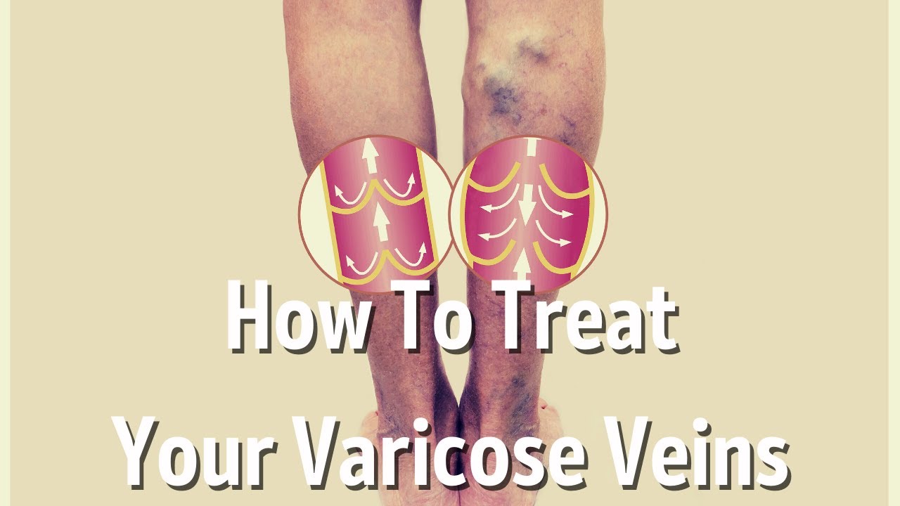 Carolina Vein Institute: Varicose Vein Specialists: Chapel Hill, NC &  Raleigh, NC