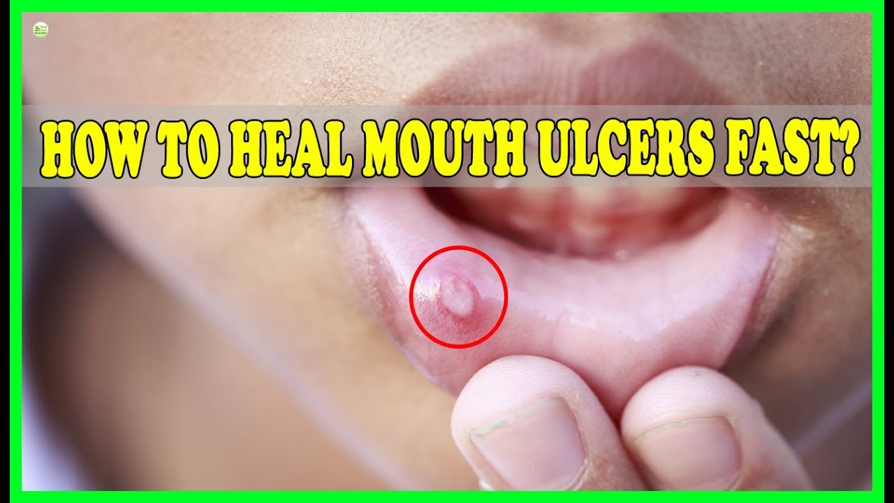 how to get rid of ulcers in your mouth fast