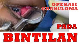 Operasi Granuloma karena Bintilan yang berlanjut