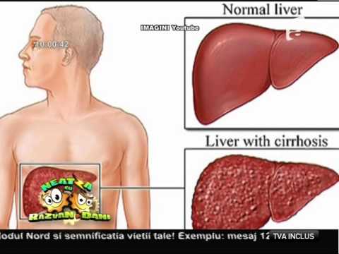Ce este hepatita A? Cum se transmite, simptome și tratament