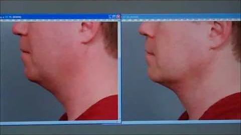 Smartlipo of the Neck - Case Study | Dr. Sterry