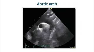 How to image the aortic arch with echocardiography