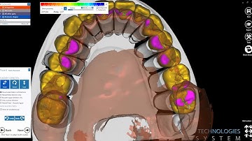 EXOCAD Telescopic crown