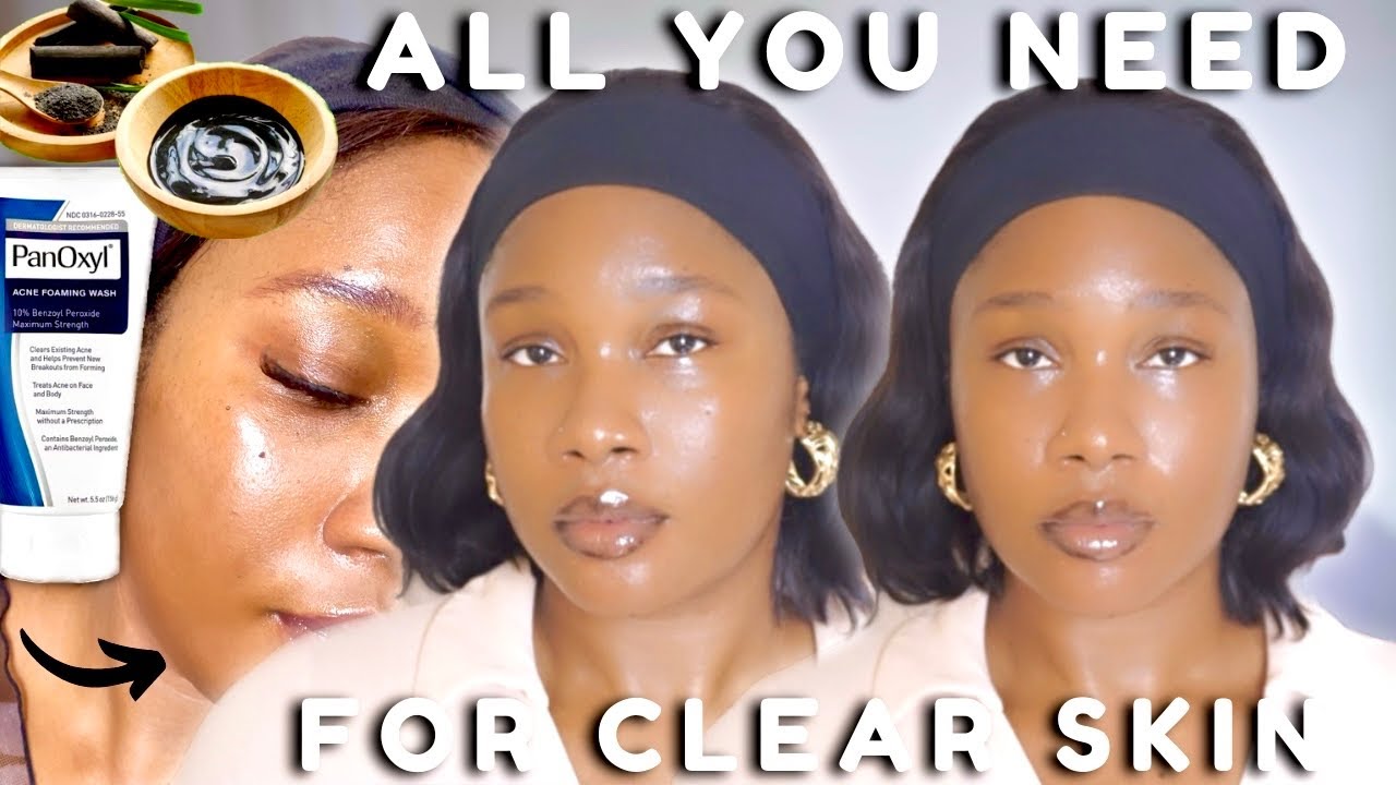 Must Have Skincare Products for Acne Prone Skin | *Oily and Dry Skin Approved *