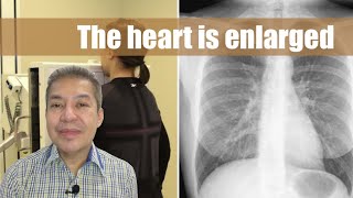 The heart is enlarged sa chest X-ray