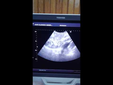 Pneumatosis portalis ultrasound